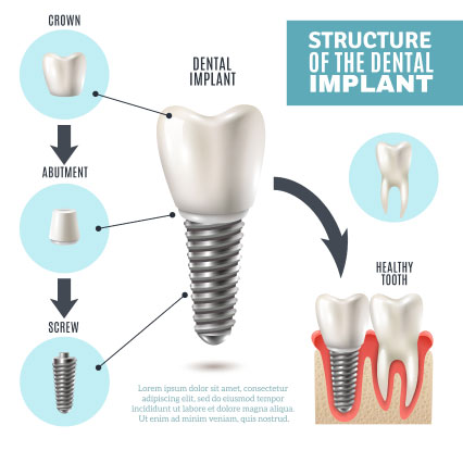 Graphic of Dental Implants